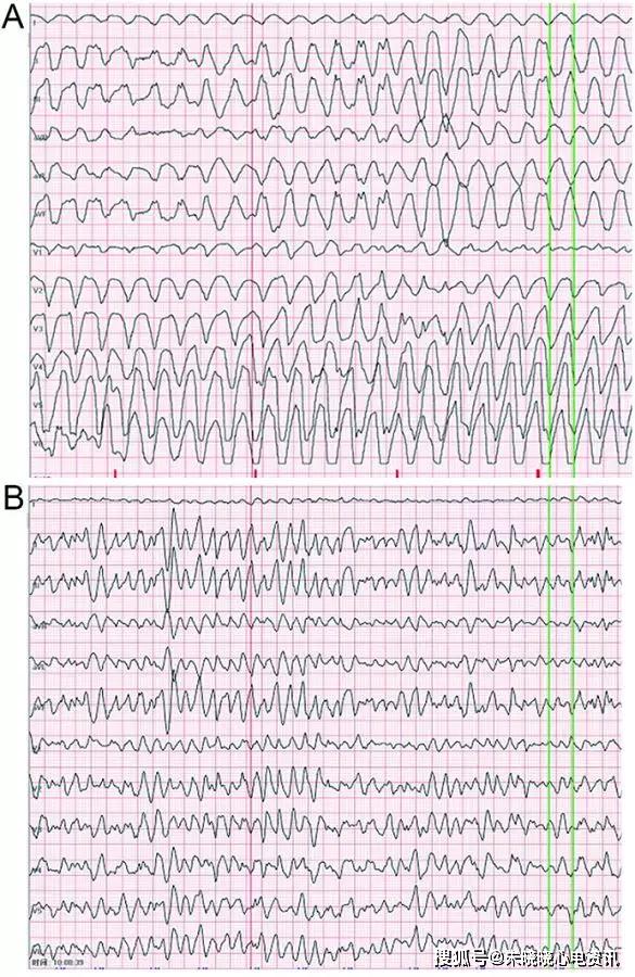 室扑室颤的心电图特点图片