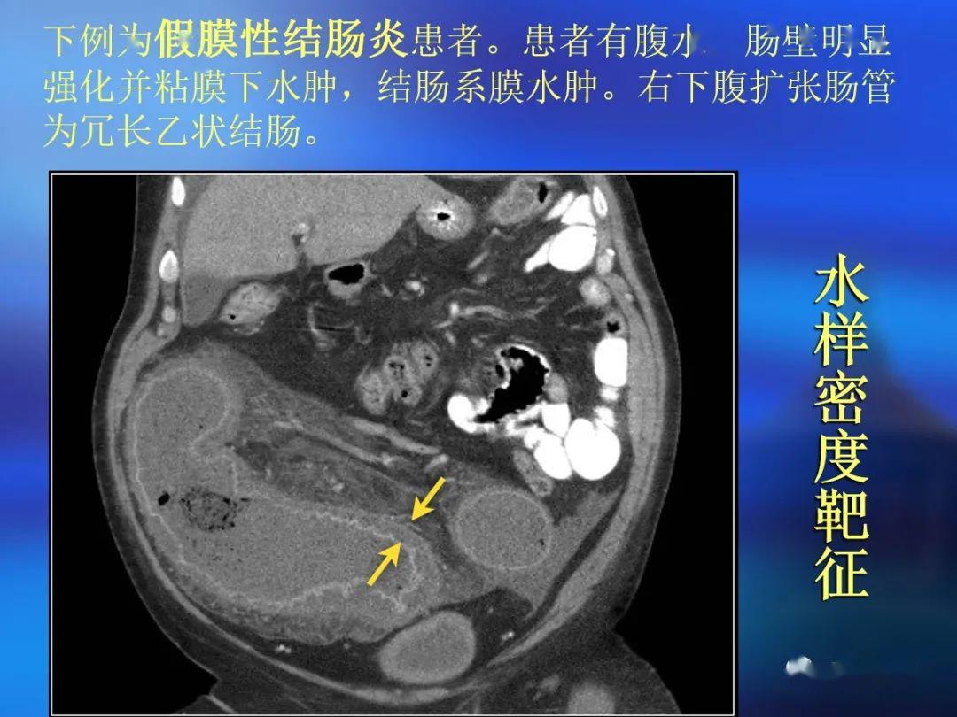 肠道壁增厚ct表现