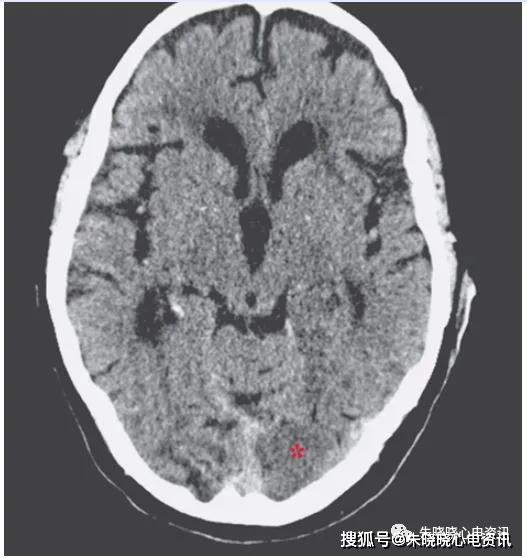 耳垂皱褶是冠心病吗?关于frank征,你应该知道的知识