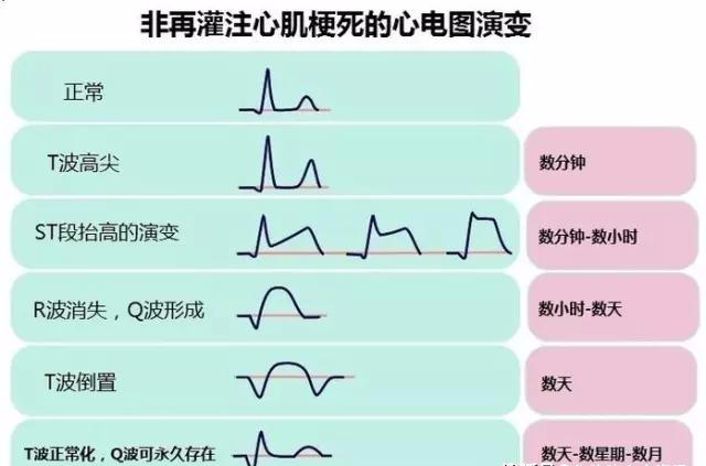 心电图如何诊断图片