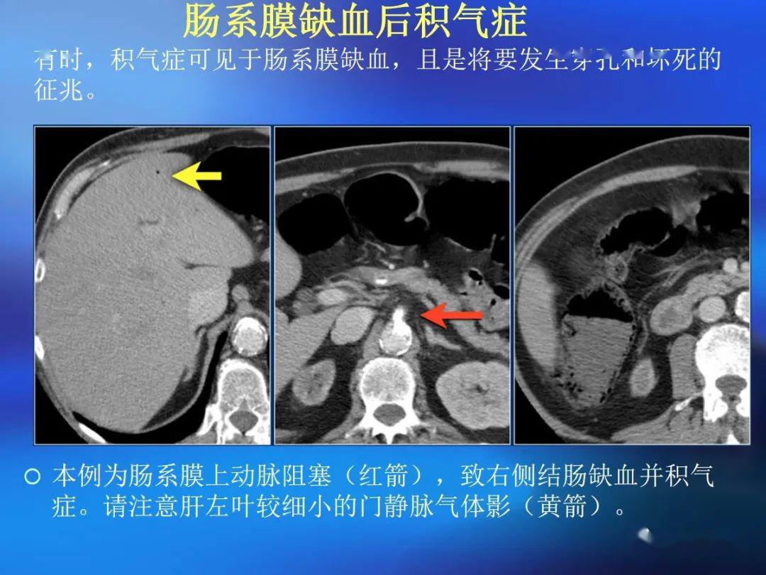 肠道壁增厚ct表现