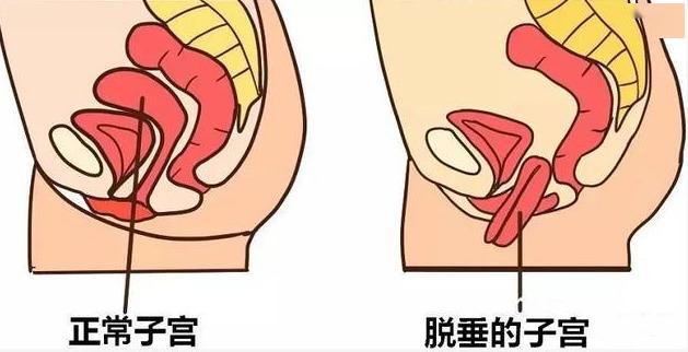 难以启齿的病女子不敢大笑也不敢喝水出远门竟是生孩子引起