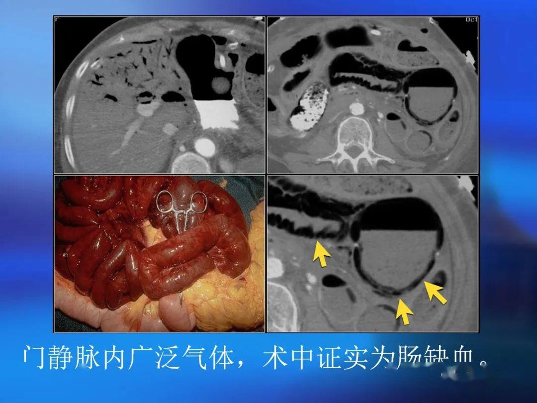 腸道壁增厚ct表現