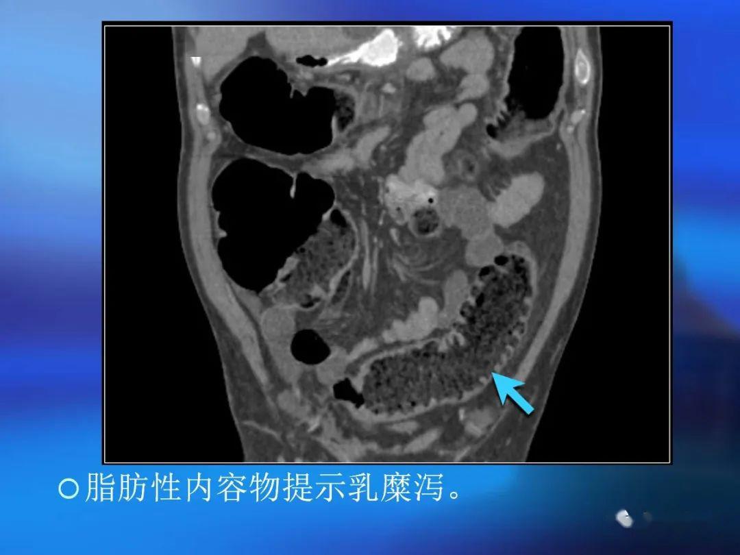 腸道壁增厚ct表現