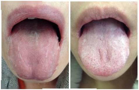 舌头就能反映你的身体健康状态对照辨别一下吧