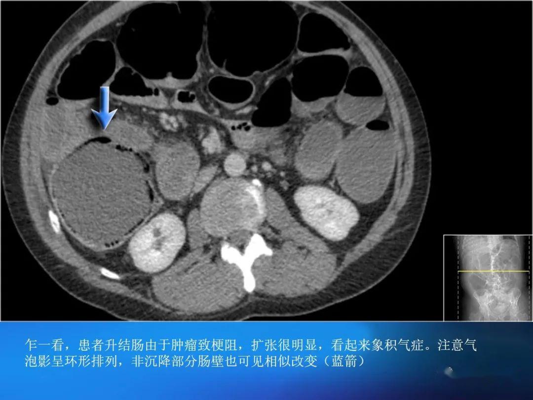 腸道壁增厚ct表現