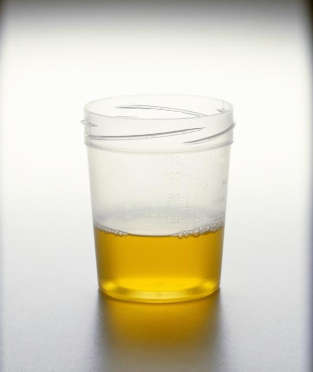 正常的尿液有泡沫吗_正常尿液有泡沫正常吗 - 舞阳县第一高级中学