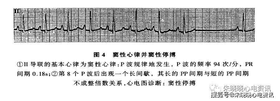 激動傳出障礙,常累及到心房,交界區和心室內傳導系統,在心電圖上表現