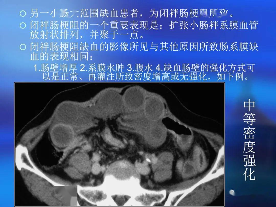 肠道壁增厚ct表现