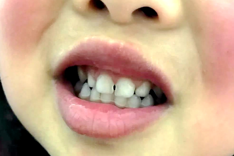 儿童蛀牙早期图片