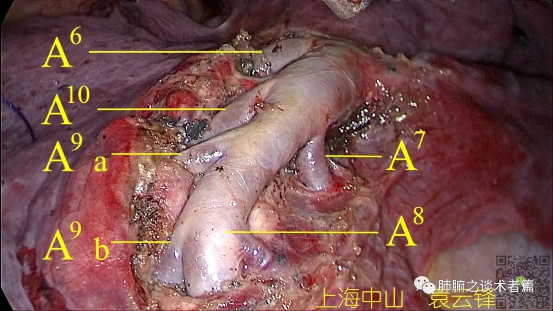 袁云锋教授rs89肺段切除详解电凝切割段面