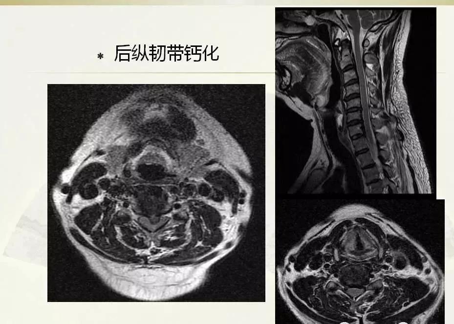 頸椎病拍了片子卻一頭霧水看不懂收藏起來