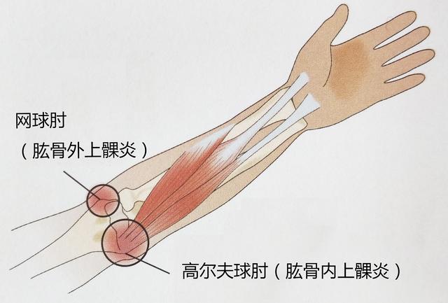 原创硬拉卧推时手肘疼痛你可能患网球肘或高尔夫球肘怎么破解