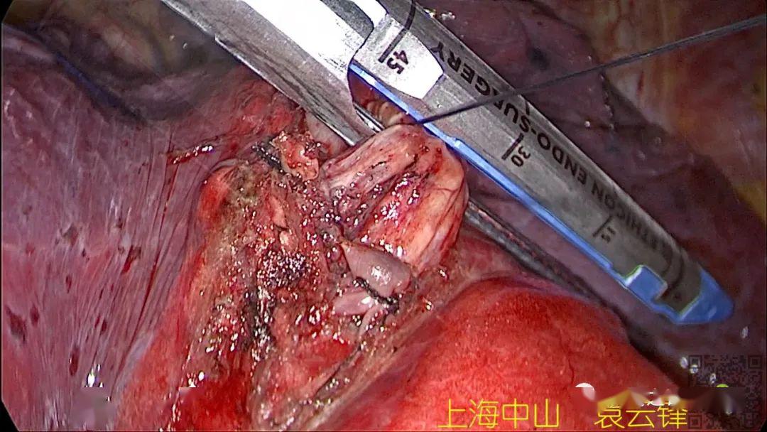 袁云锋教授rs89肺段切除详解电凝切割段面