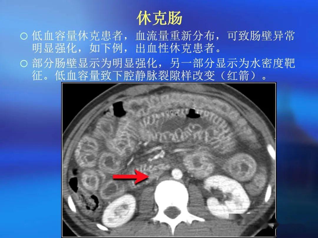 肠道壁增厚ct表现