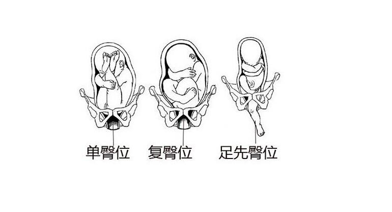 另外一种情况就是羊水过少,导致胎儿在妈妈的子宫当中受到限制,所以