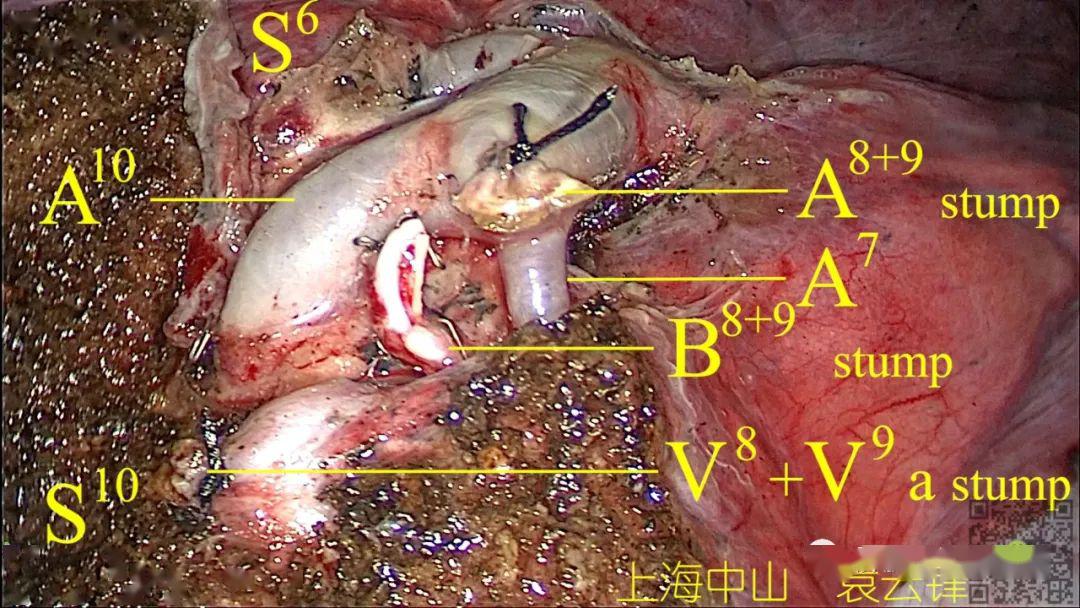 袁云锋教授rs89肺段切除详解电凝切割段面