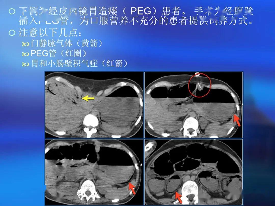 腸道壁增厚ct表現