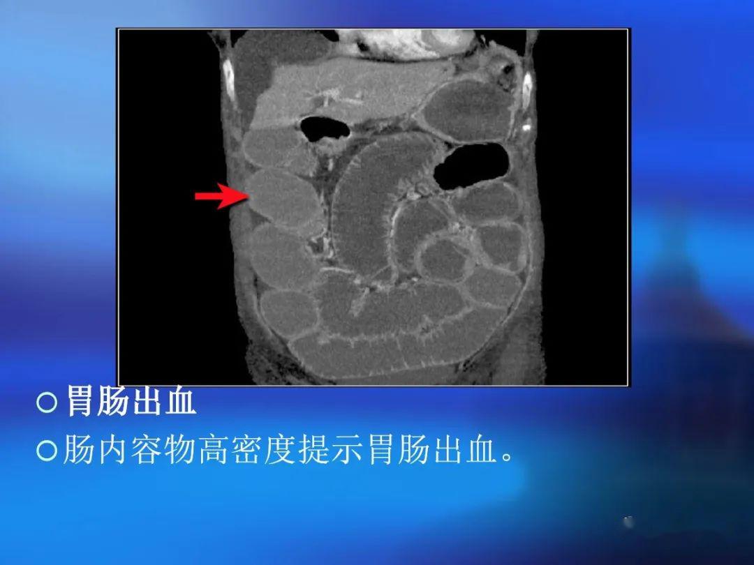 腸道壁增厚ct表現