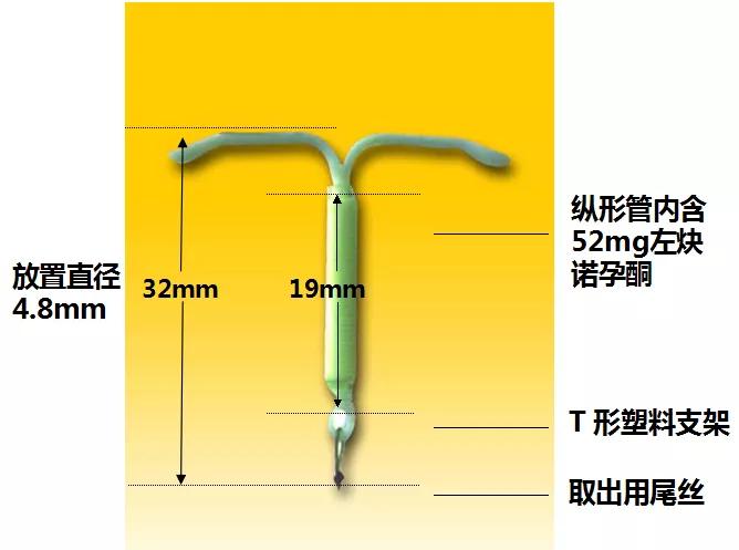 慈海醫療女性朋友的福音神奇的曼月樂環