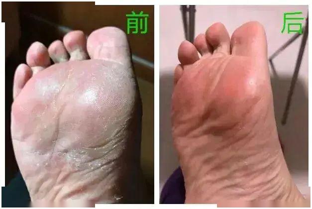 臭脚粉倒进鞋子里,不仅可以快速去除异味,还能对抗脚气5大细菌(白癣菌