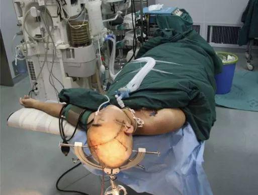 手术实战| 佟小光脑血管搭桥十年回顾之二 后循环高流量搭桥