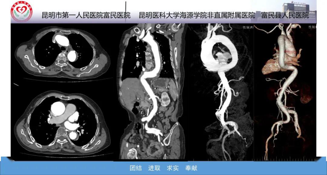 主动脉CTA图片