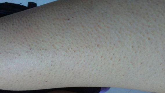 鸡皮肤是缺维生素什么(鸡皮肤是缺少维生素a还是维生素b)