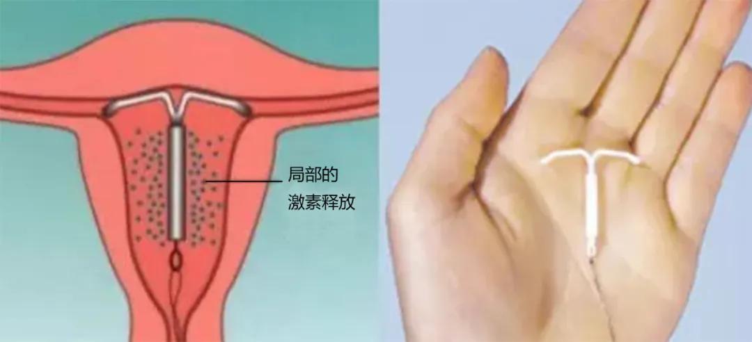 慈海医疗||女性朋友的福音——神奇的曼月乐环