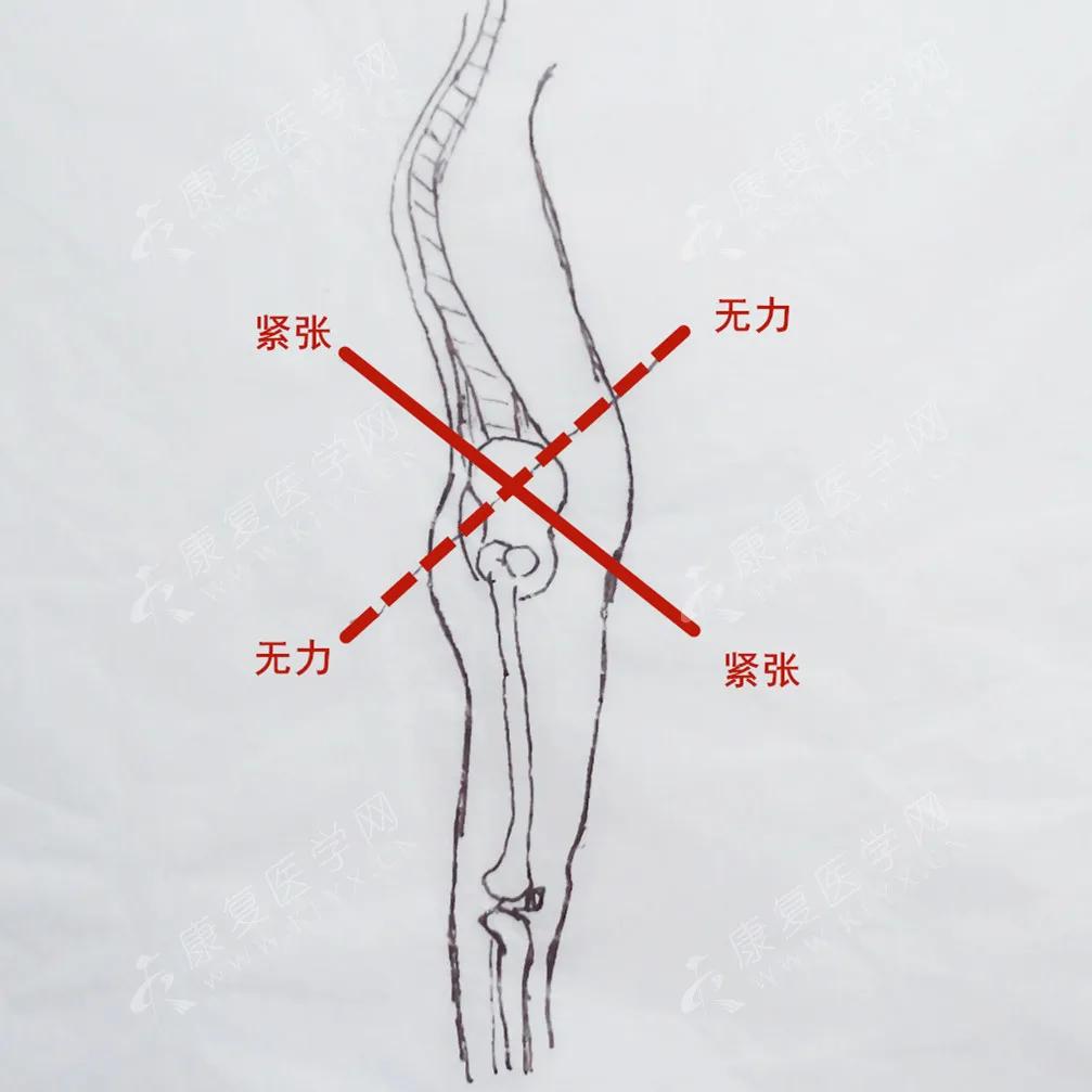 下交叉綜合徵其實在上交叉綜合徵之外還有一個下交叉綜合徵,也是影響