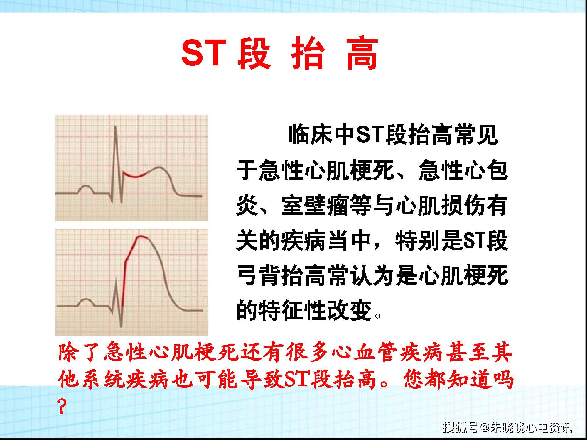 心电图背后的故事