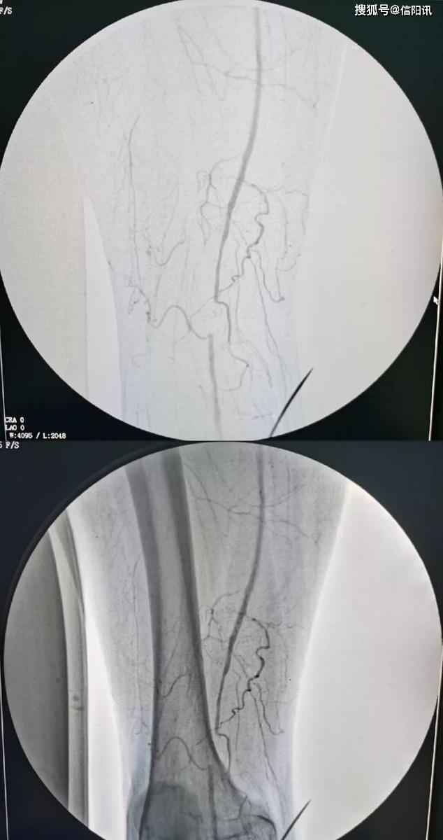 罗山县人民医院下肢动脉闭塞介入技术新进展——药物涂层球囊扩张术