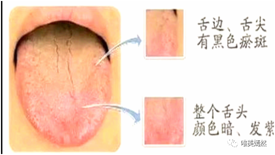 花剥:剥落不全,剥落处光滑无苔主胃气阴两伤;剥落而有腻苔主痰湿未化