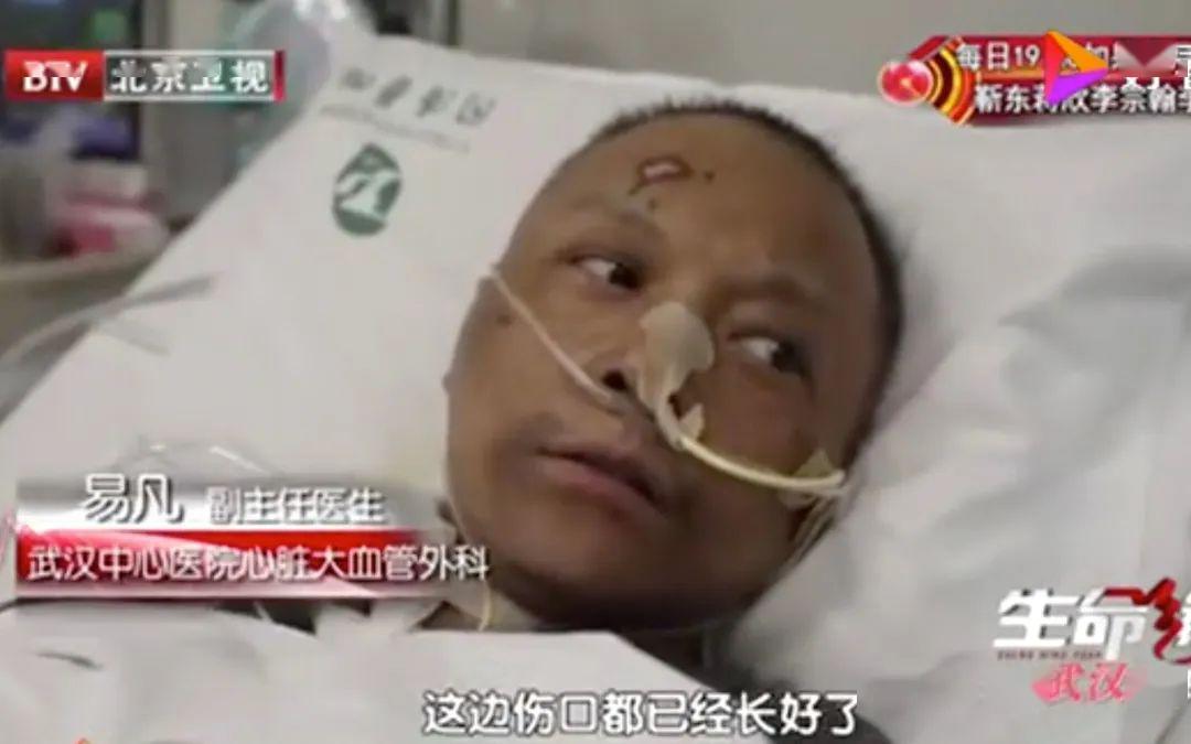 武汉中心医院两医生患新冠后皮肤变黑,系药物致色素沉着