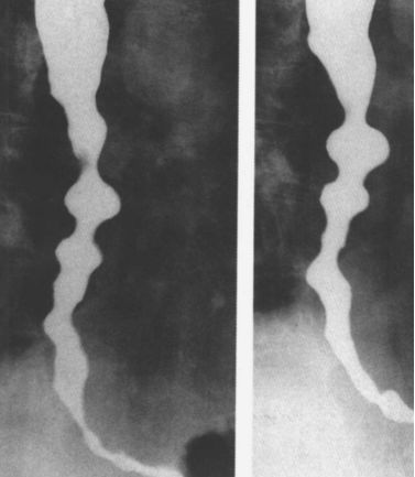 鉴别诊断食管疾病只需简单一句话