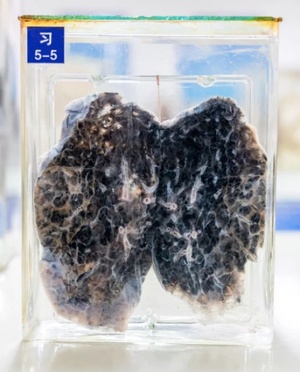 肺癌是如何早发现当频繁有这4个症状时应该及时就医