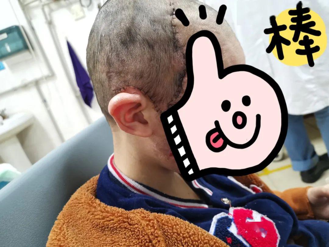 6岁娃娃患罕见兽皮症疫情打乱治疗计划绵阳北京联手救急