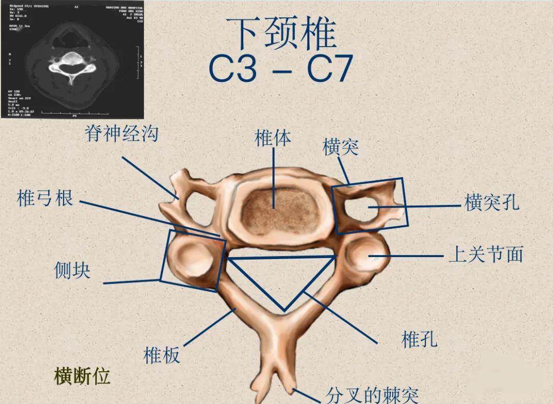 下颈椎(c3 -c7)棘突 (分叉)关节面侧块,较大横突——横突孔,椎动脉