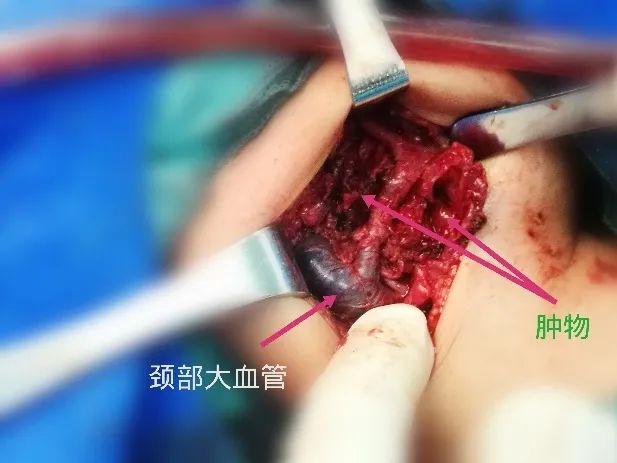 囊肿多大需要手术 来自搜狐网