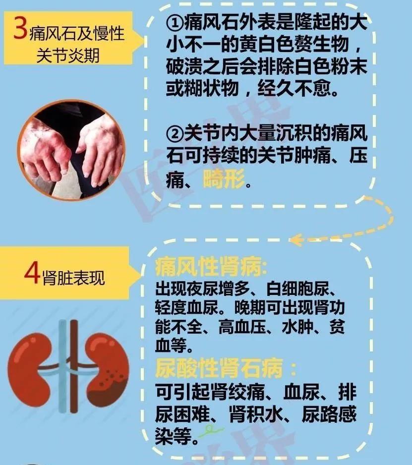 世界痛风日困扰大众的王者之痛痛风的病因与治疗