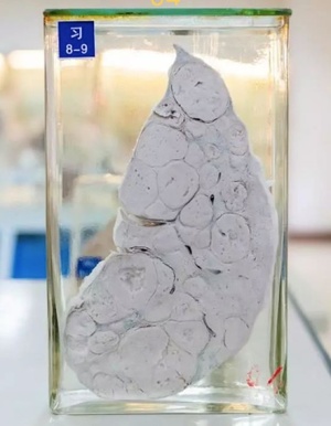 肺癌是如何早发现当频繁有这4个症状时应该及时就医