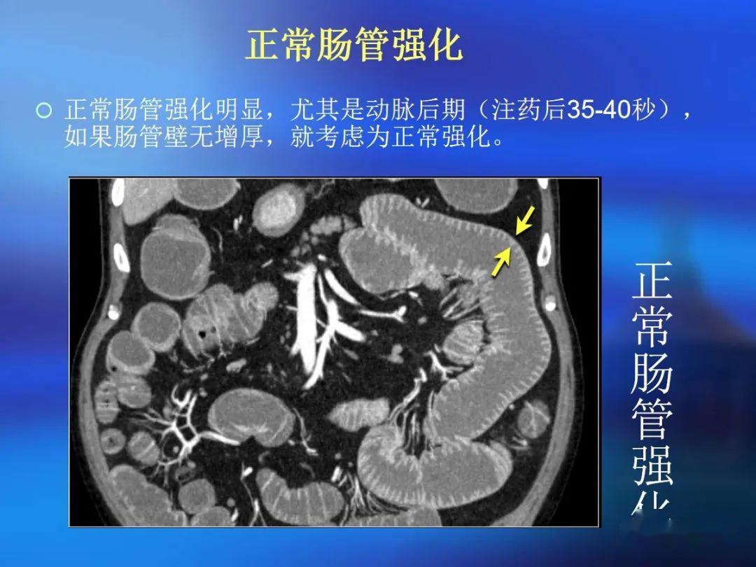 肠道壁增厚ct表现
