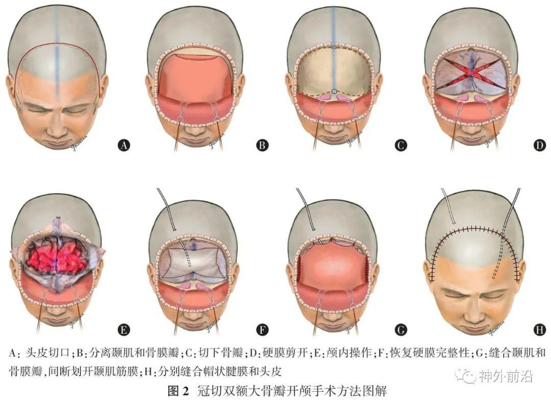 中国成人重型颅脑损伤大骨瓣开颅手术标准技术专家共识中华神经创伤