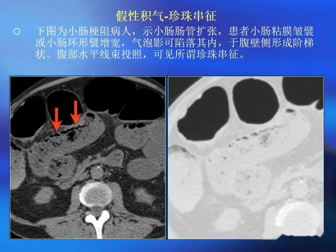 肠道壁增厚ct表现
