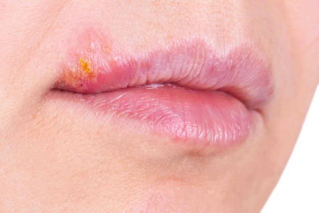 烂嘴角是免疫力差的象征三分钟检测免疫力方法就在这里