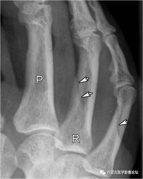 x线诊断要收藏的7个手部正常征象片子