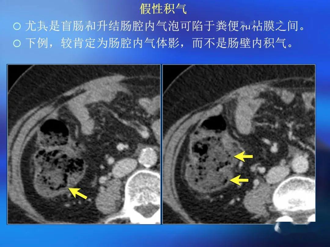 肠道壁增厚ct表现