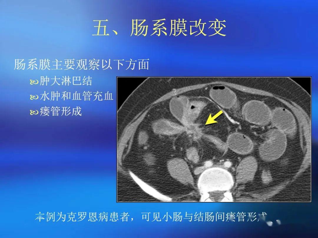 肠道壁增厚ct表现