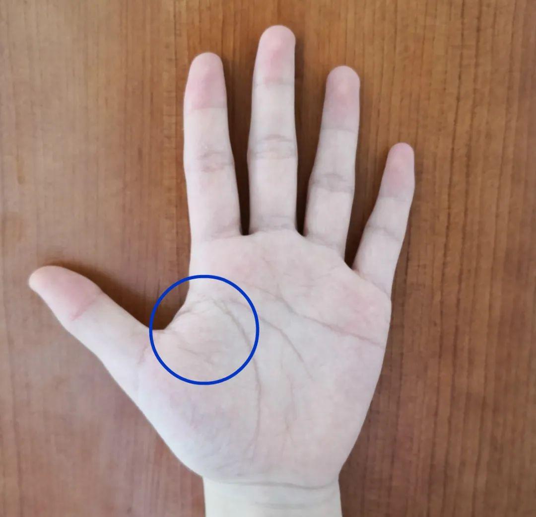 年轻人虎口青筋,则可能预示心脑血管畸形,建议进行脑血管检查.