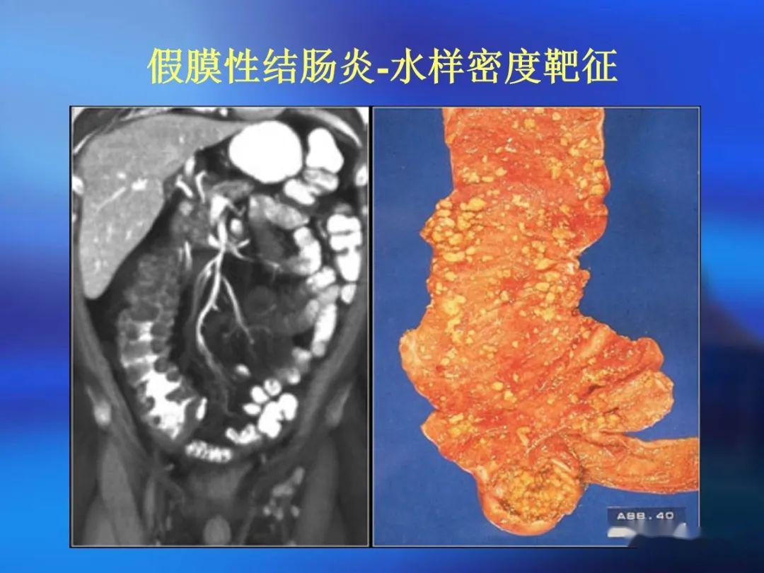 肠道壁增厚ct表现